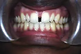 gadson-before-midline