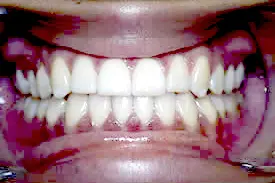 gaskin-midline-after