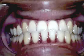 gaskin-midline-before