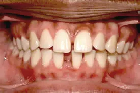 moore-before-midline