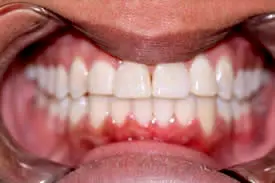 pearson-midline-after