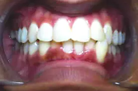 pearson-midline-before