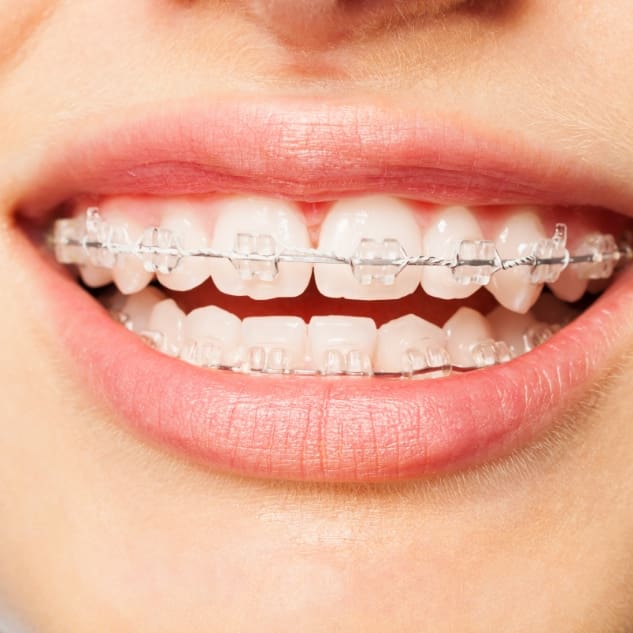 Close-up of a smiling mouth with braces on teeth. The braces have clear brackets, emphasizing dental care and orthodontic treatment. The tone is positive.