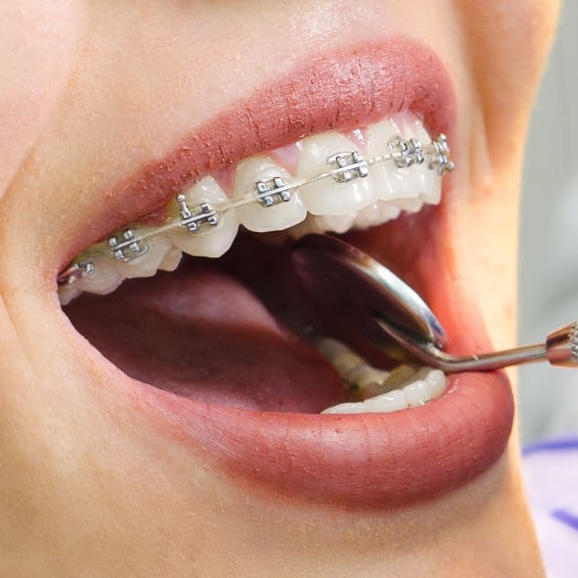 Close-up of a person's mouth with metal braces. A dental mirror is inserted, reflecting teeth alignment. The scene conveys a dental check-up.