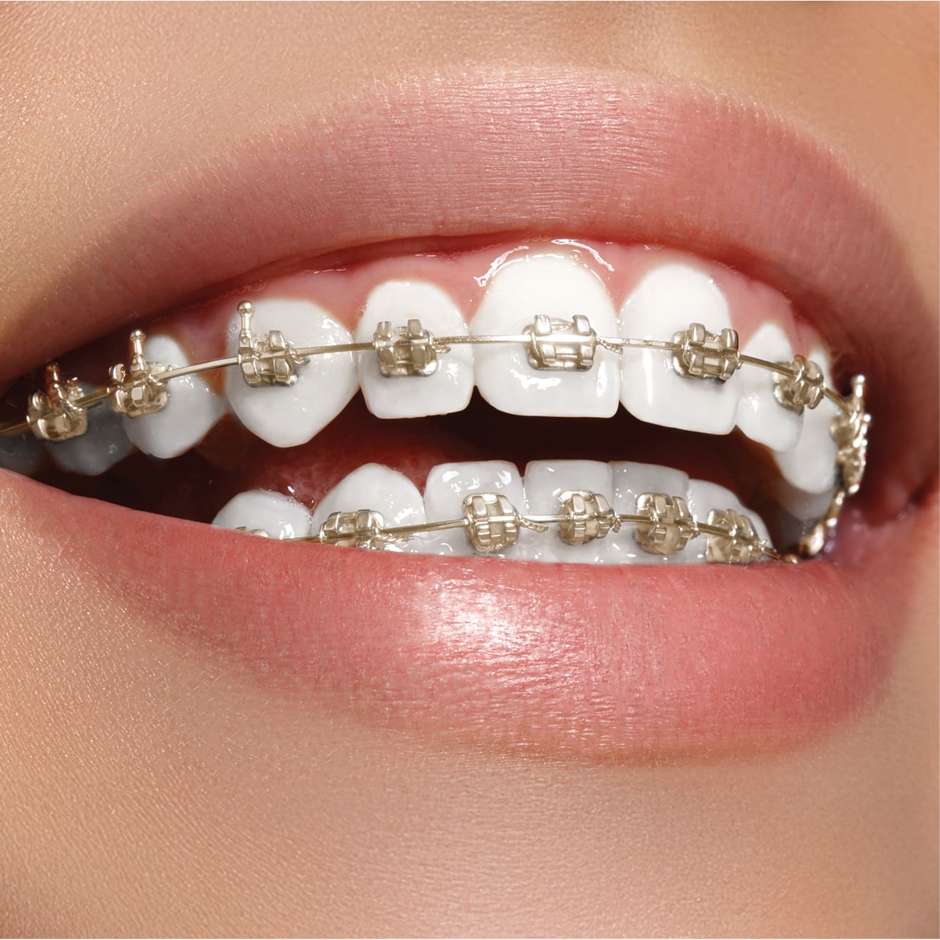 gold braces